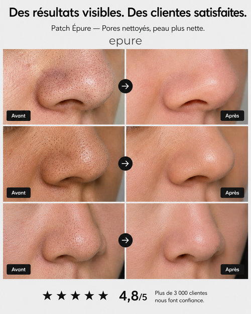 Epure Patch Nez